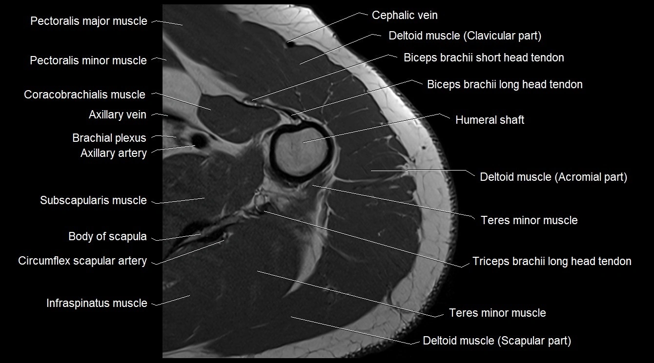 Upper arm( humerus) cross section anatomy MRI 3T axial image 16.webp